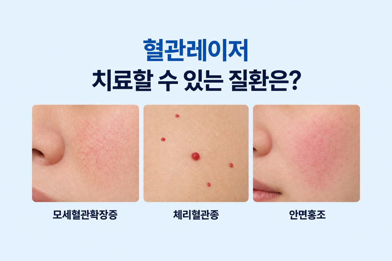 모세혈관확장증, 체리혈관종, 안면홍조 이미지와 함께 혈관레이저로 치료할 수 있는 질환을 소개하는 썸네일