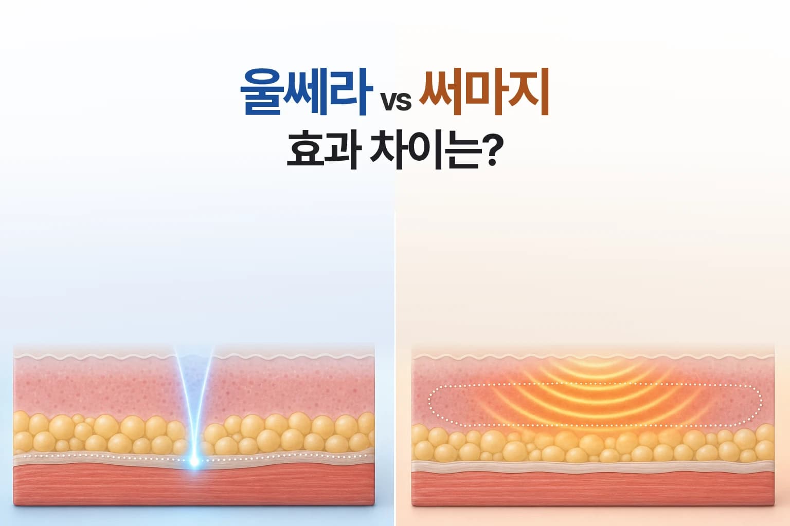 울쎄라와 써마지의 피부 속 에너지 전달 범위를 비교한 썸네일