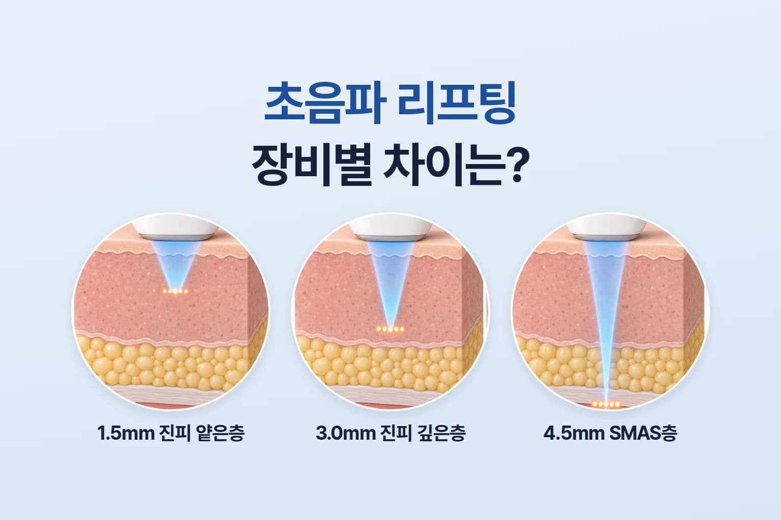 초음파 리프팅 장비별 핸드피스와 카트리지의 작용 깊이를 비교한 썸네일